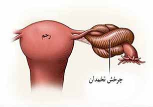 چرخش تخمدان