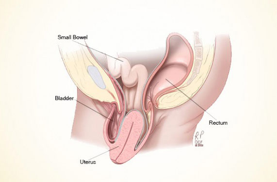 افتادگی ارگان های رحم 