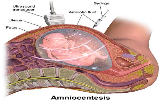 آزمایش آمنیوسنتز چیست؟ 