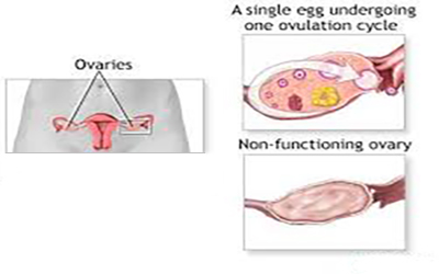 نارسایی تخمدان 