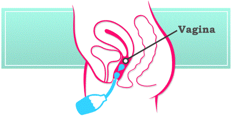 دوش واژینال چیست؟