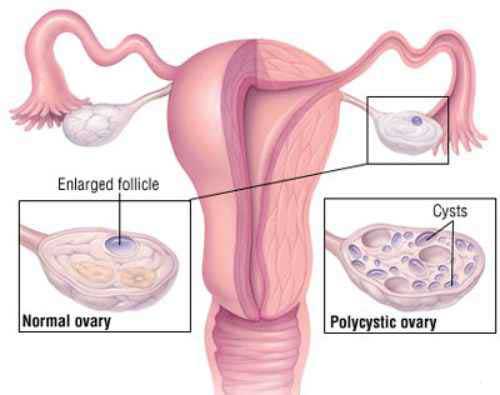 تنبلی تخمدان در دختران جوان
