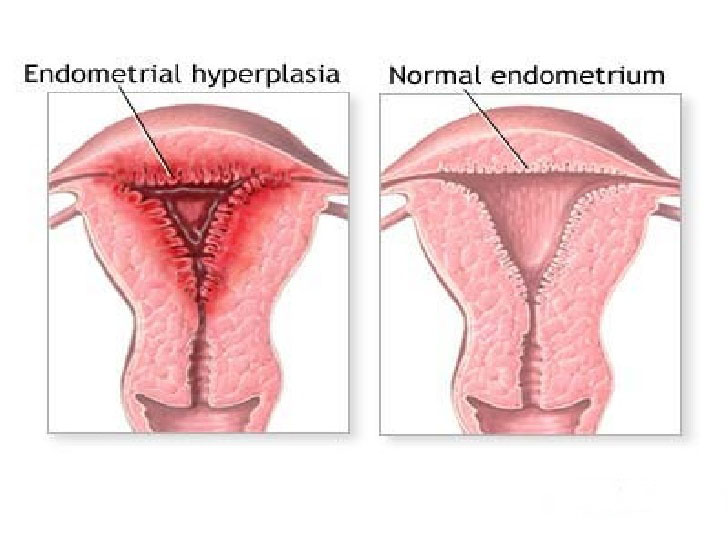هیپرپلازی آندومتر رحم