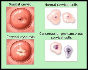 دیسپلازی دهانه رحم؛ علائم، علل، پیشگیری و درمان