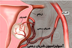 امبولیزاسیون برای درمان فیبروم رحمی