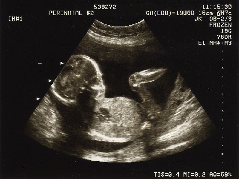سونوگرافی آنومالی چیست و در کدام هفته از بارداری انجام می شود؟