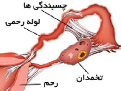 انسداد لوله رحمی در نازایی