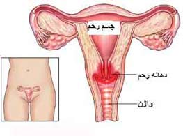 آشنایی بیشتر با انواع بیماری های دهانه رحم