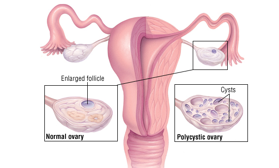 بیماری های تخمدان
