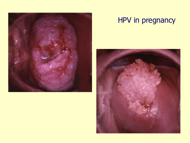 زگیل تناسلی در بارداری