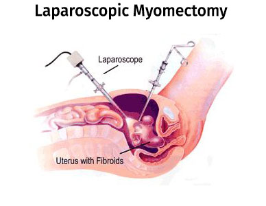 عمل جراحی فیبروم رحم یا میومکتومی 