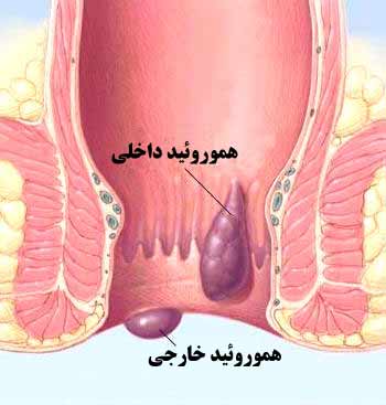 هموروئید در بارداری چیست؟