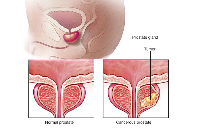 سرطان پروستات در مردان
