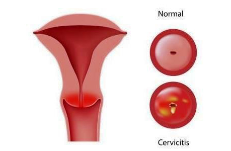 سرویست یا التهاب دهانه رحم