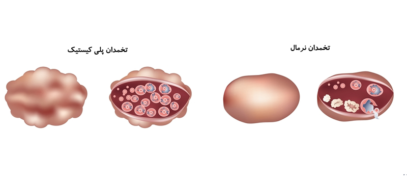 تشخیص و علائم سندرم تخمدان پلی‌کیستیک