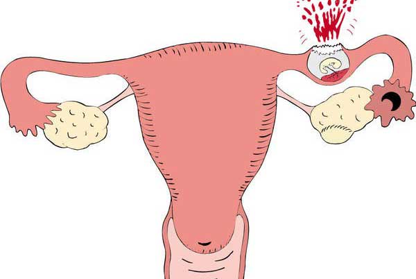  علایم بارداری خارج از رحم