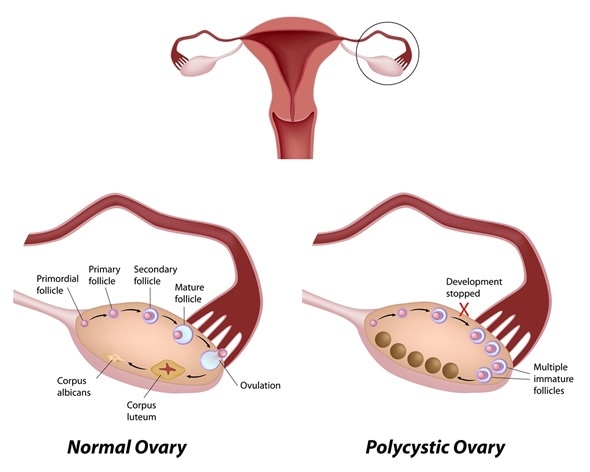 عوارض تخمدان پلی کیستیک در بارداری 