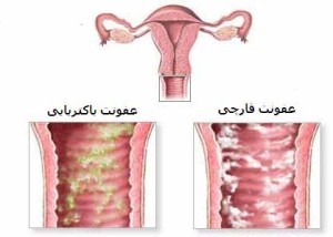 عفونت زنانه شایع ترین بیماری زنان