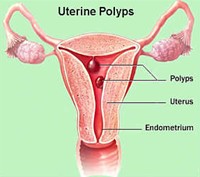 تشخیص و درمان پولیپ رحم