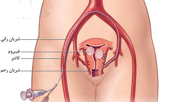 آمبولیزاسیون یا بستن شریان رحمی برای درمان فیبروم رحمی