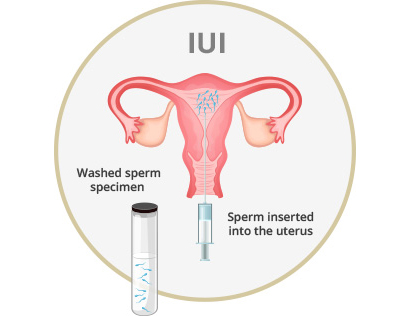 IUI چیست؟