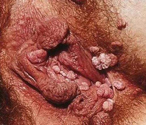 HPV/ زگیل تناسلی 