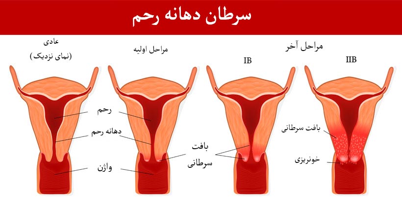 علائم ابتلا به سرطان دهانه رحم