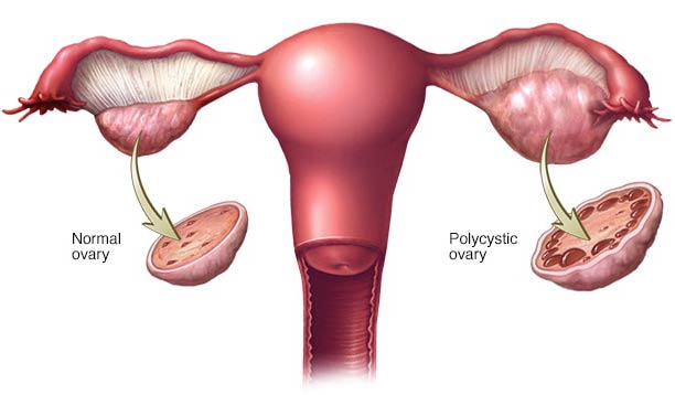 علائم تخمدان پلی کیستیک