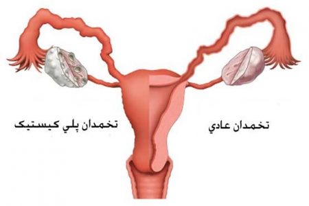 اختلالات هورمونی ناشی از تخمدان پلی کیستیک