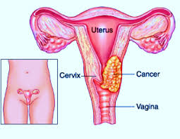 همه چیز درمورد سرطان دهانه رحم