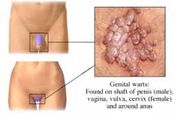 علل و راههای پیشگیری زگیل تناسلی
