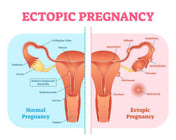 حاملگی خارج از رحم چگونه اتفاق می‌افتد؟