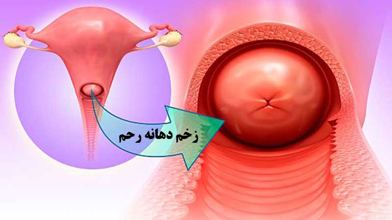 زخم دهانه رحم چیست و به چه علتی به وجود می آید؟