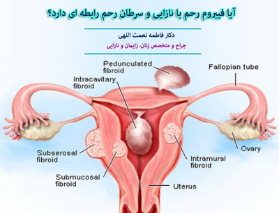 آیا فیبروم رحم با نازایی و سرطان رحم رابطه ای دارد؟