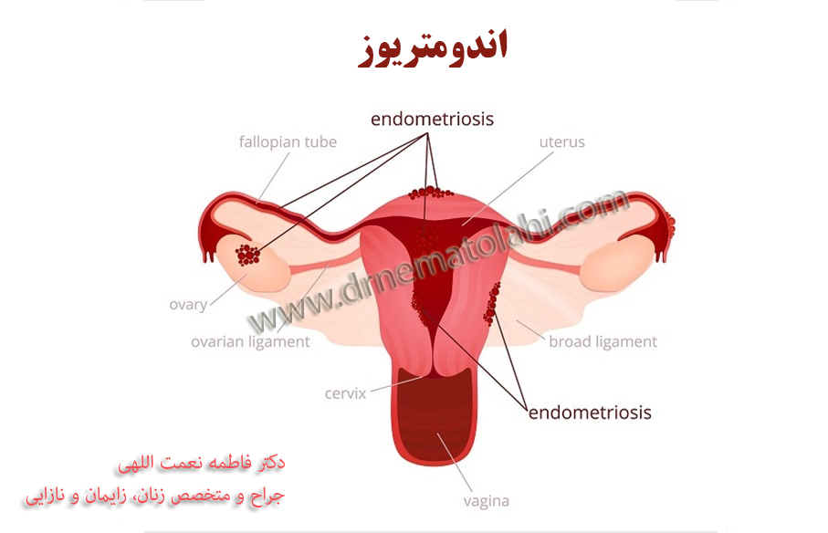 اندومتریوز : عامل مشترک درد قاعدگی و نازایی 