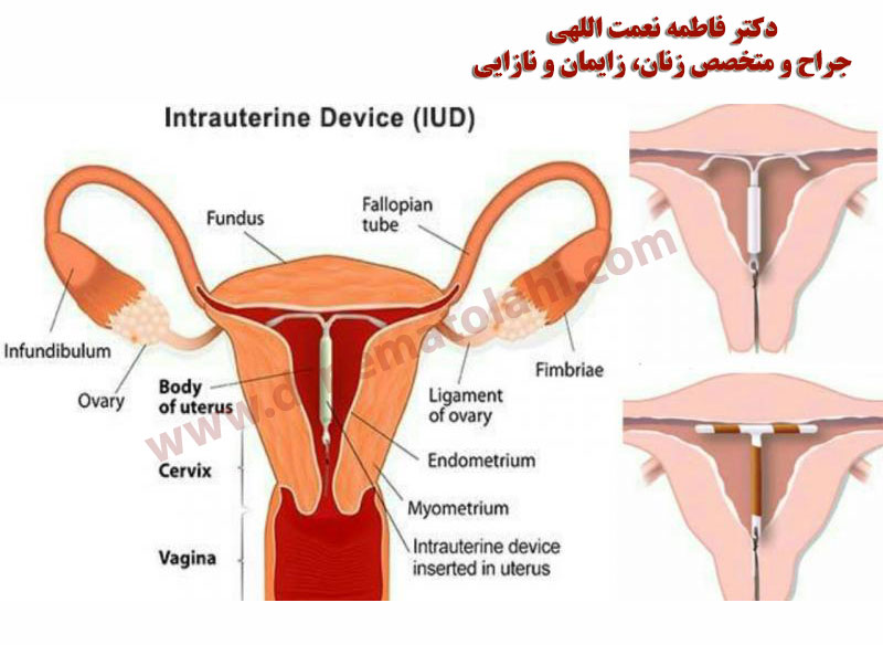 آشنایی با انواع IUD