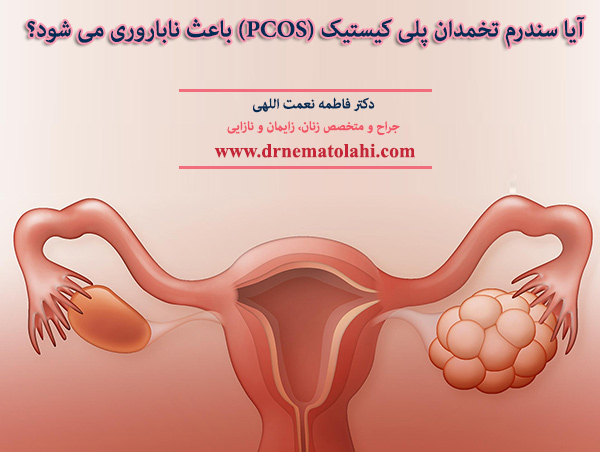 سندرم تخمدان پلی کیستیک (PCOS) 