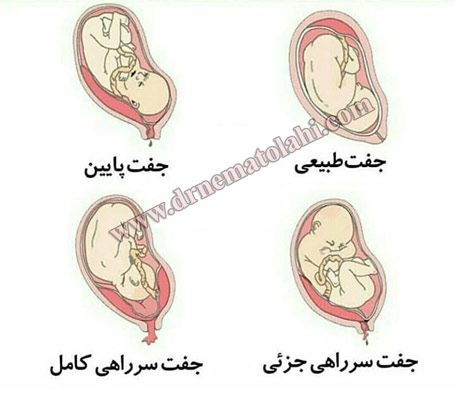 جفت سر راهی چیست؟ 