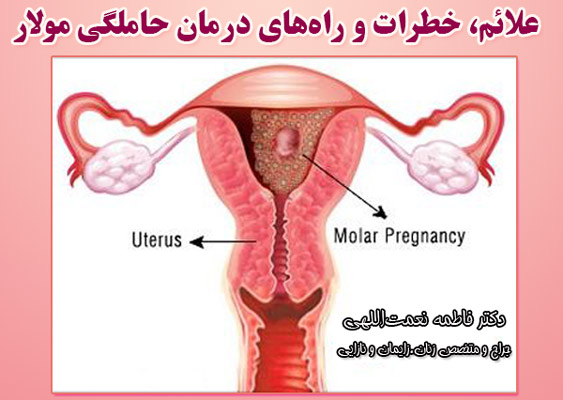 علائم، خطرات و راه‌های درمان حاملگی مولار