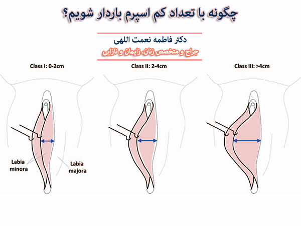 باورهای رایج در مورد لابیا