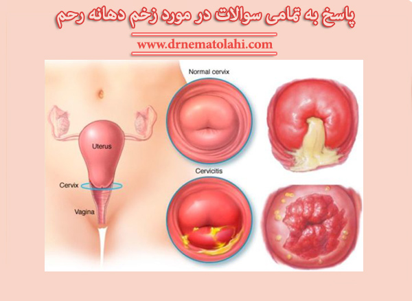 پاسخ به تمامی سوالات در مورد زخم دهانه رحم