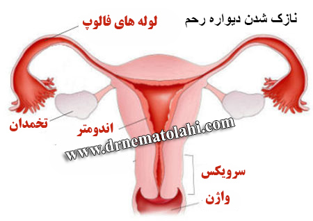 نازک شدن دیواره رحم