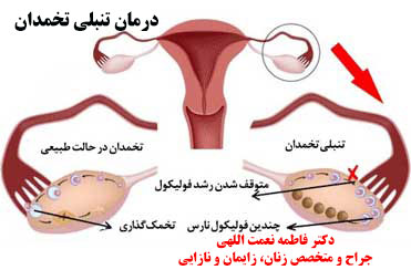 درمان تنبلی تخمدان