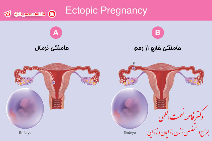 تشخیص حاملگی خارج از رحم