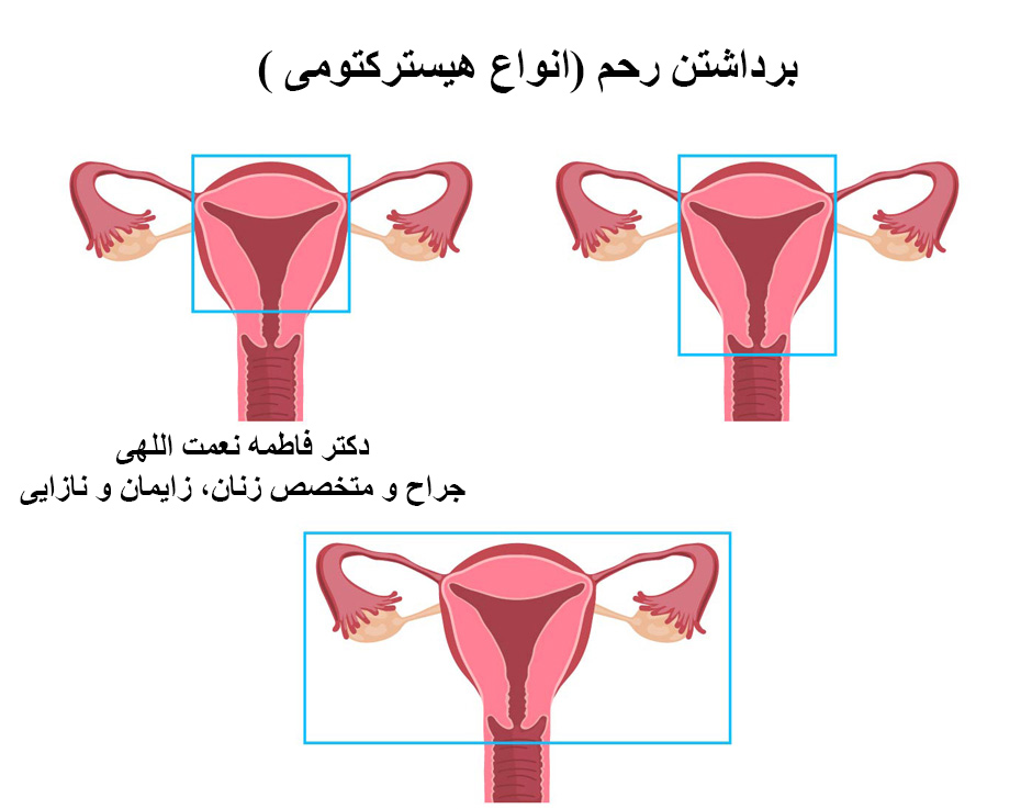 رابطه و میل جنسی بعد از برداشتن رحم 