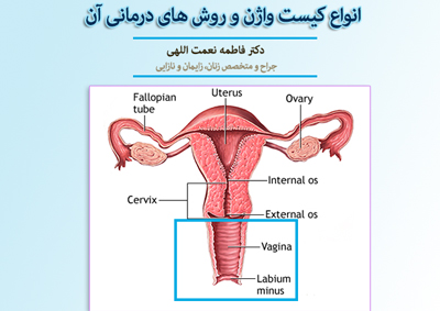 انواع کیست واژن و درمان آن