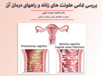 عفونت های زنان 