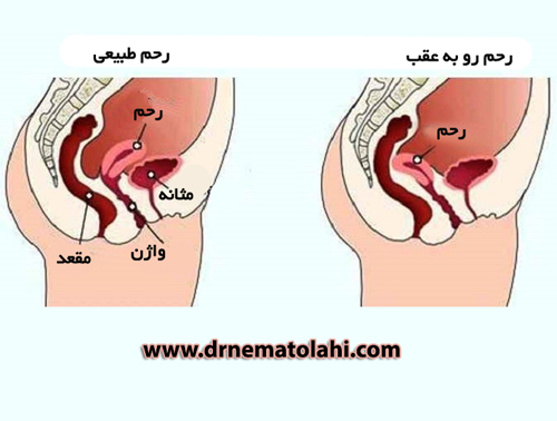 رحم رو به عقب چه تاثیری در بارداری دارد؟