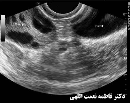 کیست پارااورین تخمدان