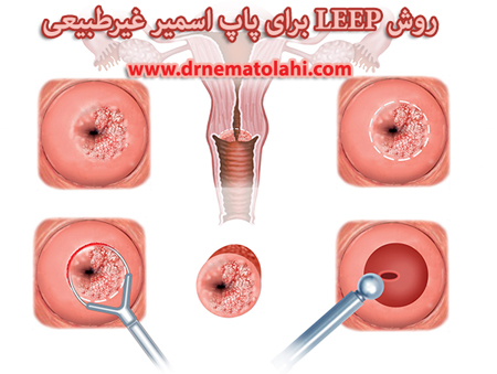 روش LEEP برای پاپ اسمیر غیرطبیعی